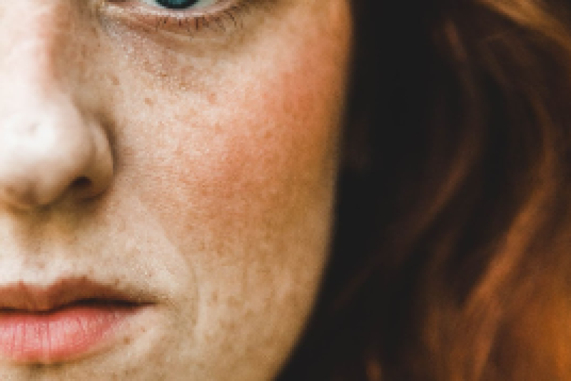 Banishing Brown Spots and Red Dots - Reversing Sun Damage and Aging