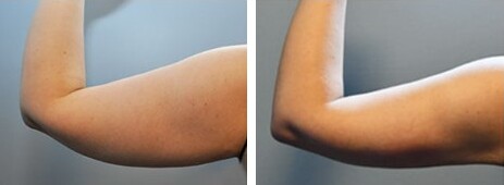 Arm Liposuction Before and After