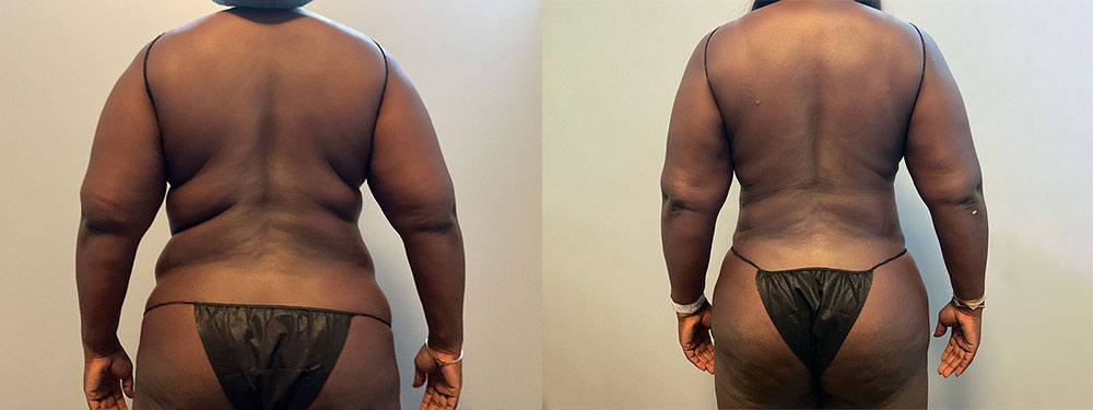 Female Back Liposuction Before and After