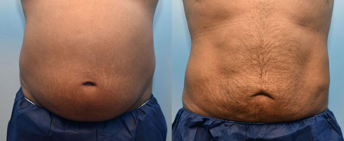 Male Abdomen Liposuction Before and After