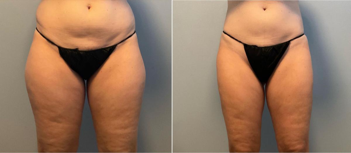 Leg Liposuction Before and After