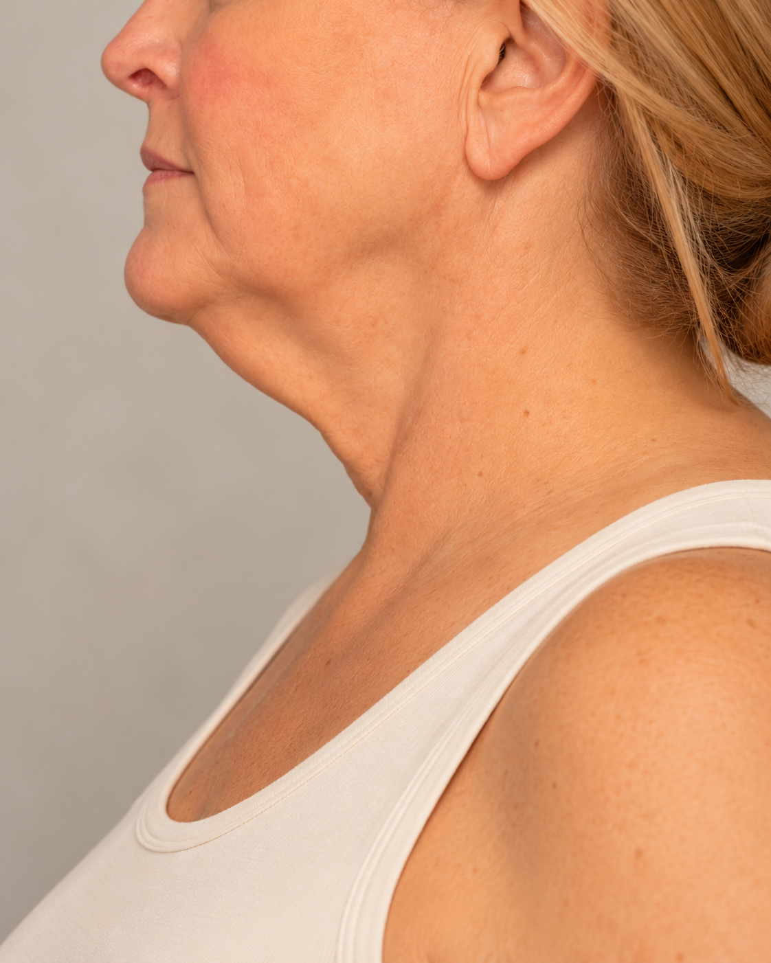 Close-up photograph illustrating the chin treatment area